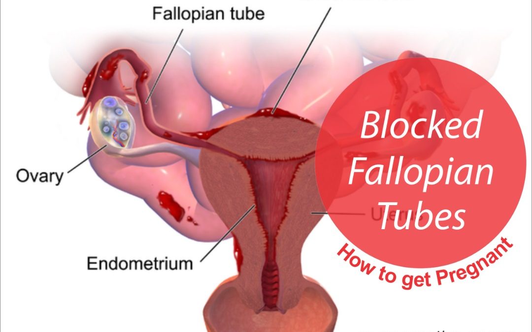 BLOCKED FALLOPIAN TUBES AND HOW TO GET PREGNANT EASILY