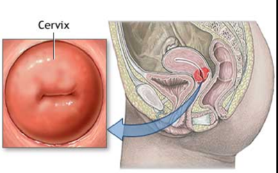 Incompetent Cervix: Understanding the Concerns Associated with It!
