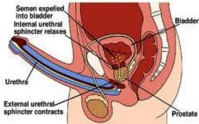 WHAT DOES RETROGRADE EJACULATION MEAN?