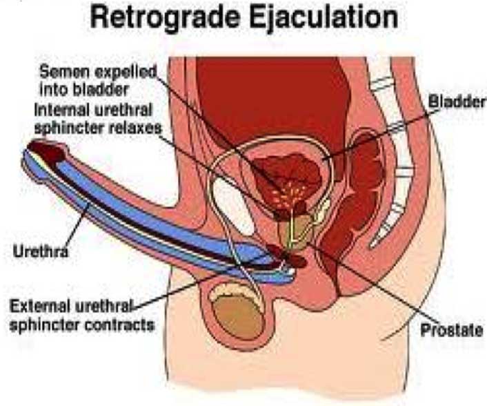What is retrograde ejaculation?