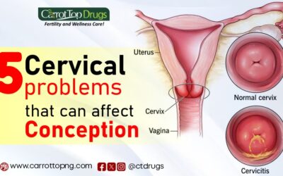 5 Cervical Problems That Can Affect Conception
