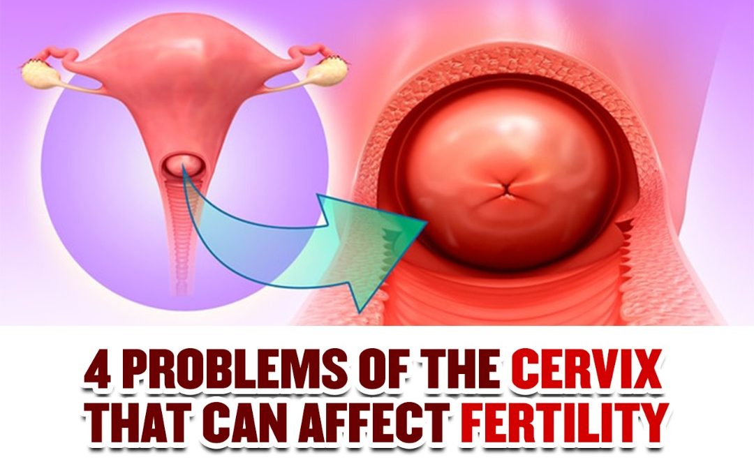 4 Problems of the Cervix that can affect Fertility