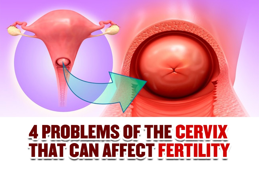 4 problems of the cervix that can affect fertility
