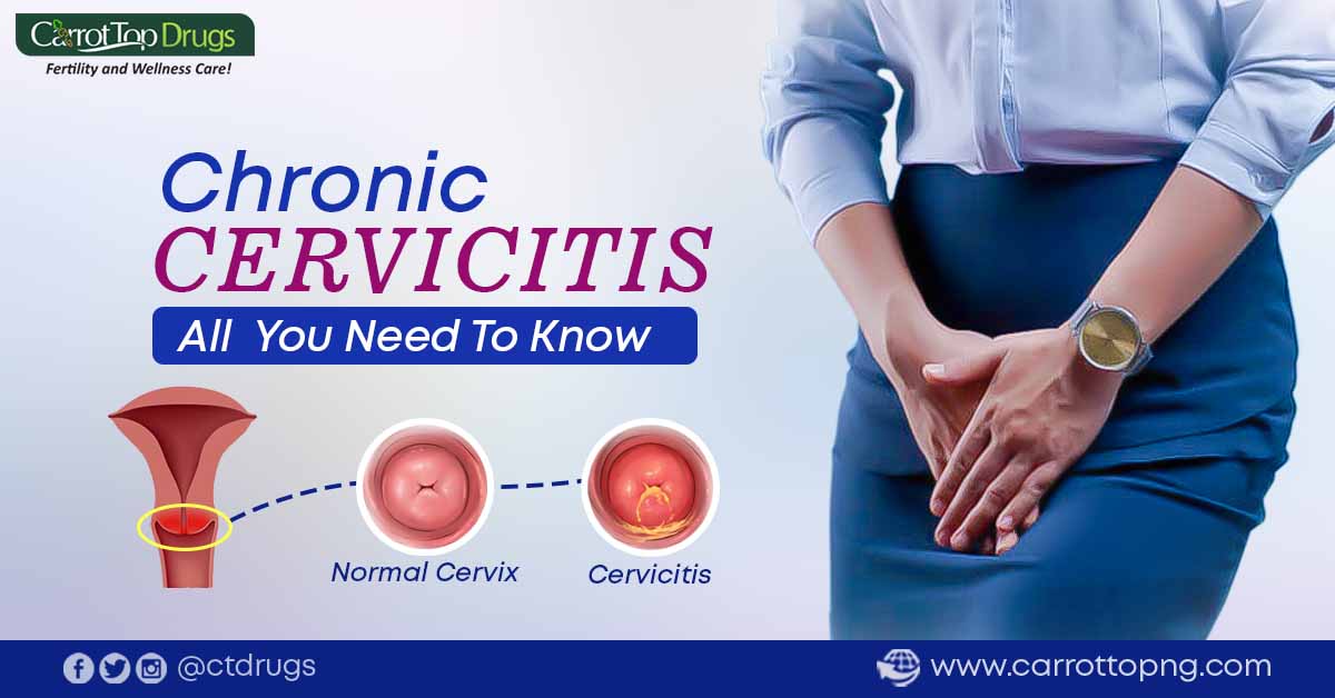 Chronic Cervicitis: All You Need To Know About.