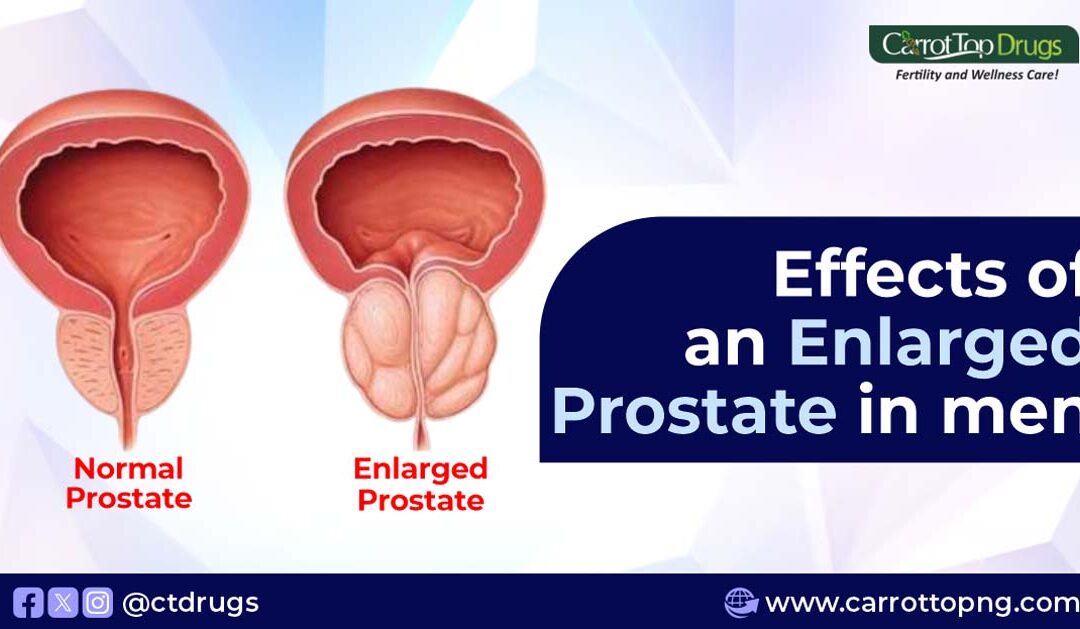 Effects of An Enlarged Prostate In Men