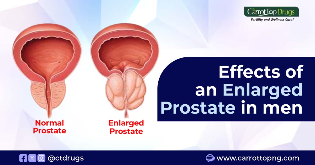 Effects-of-an-enlarged-prostate-in-men