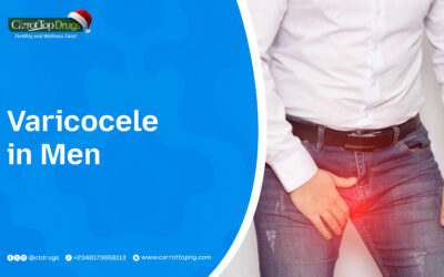 Varicocele in Men