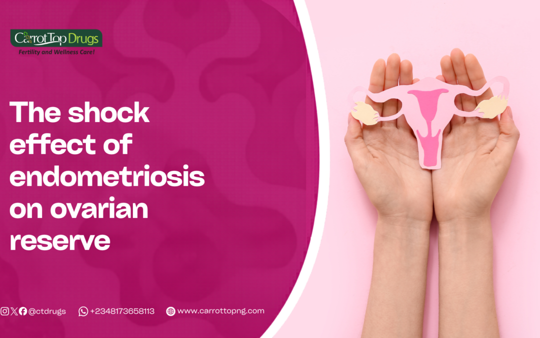The Shocking Effect of Endometriosis on Ovarian Reserve.