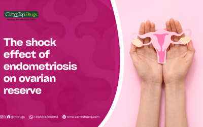The Shocking Effect of Endometriosis on Ovarian Reserve.